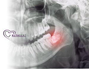 Ağrılı yirmi yaş dişlerini rahatlatmanın yolları