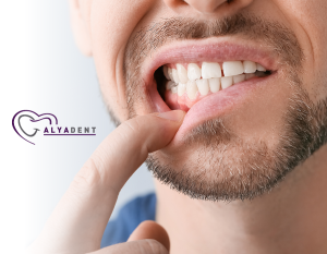 Diş Eti Çekilmesine Doğal Yöntemlerle Tedavi