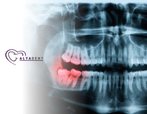 20 Yaş Dişleri Nedir ve Ne Zaman Çıkartılır