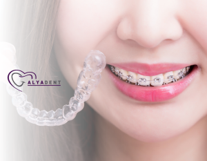 Diş Teli İçin En İyi Yaş Nedir