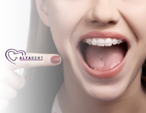 Tel Takmadan Önce Bilmeniz Gerekenler