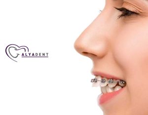 Neden dişlerimi düzelteyim?