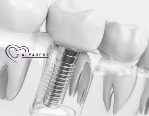 Diş İmplantlarınızın Bakımını Yapmanın En İyi 9 Yolu